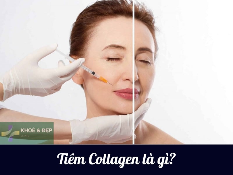 Phương pháp tiêm collagen là gì?