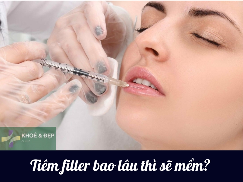 Tiêm filler bao lâu thì mềm?