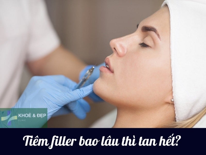 Tiêm filler bao lâu thì tan hết?