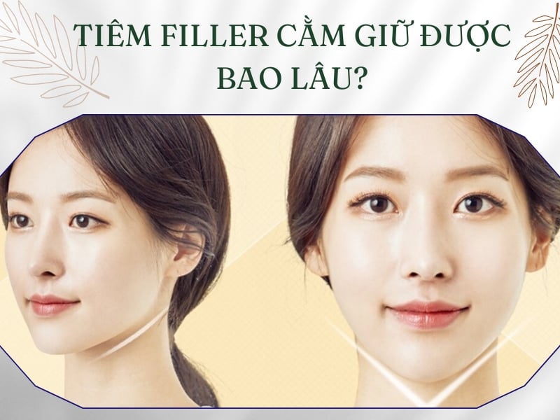 Tiêm filler cằm giữ được bao lâu?