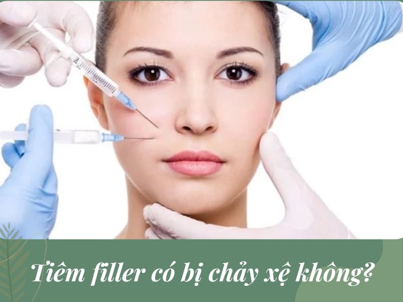 Tiêm filler có bị chảy xệ không?