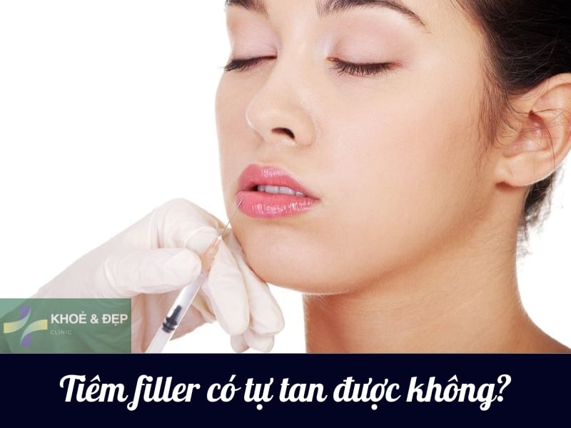 Tiêm filler có tự tan được hay không?