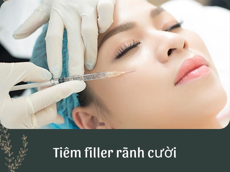 Tiêm filler rãnh cười