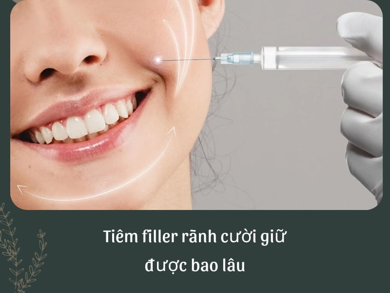 Tiêm filler rãnh cười duy trì được bao lâu?