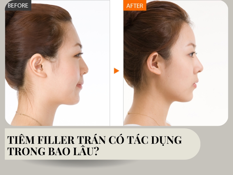 Tiêm filler trán có tác dụng trong bao lâu?