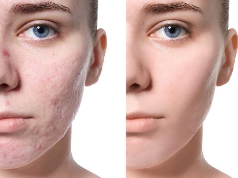 Tiêm filler trị sẹo