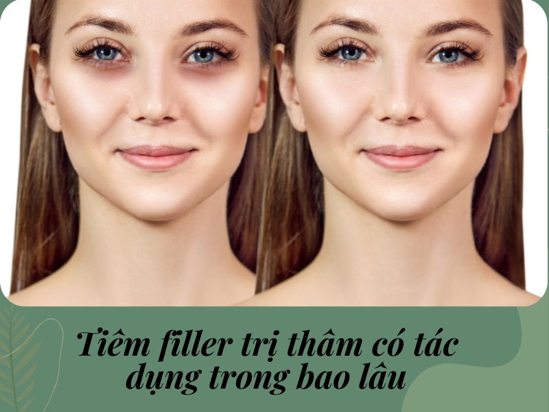 Tiêm tan quầng mắt có tác dụng trong bao lâu?