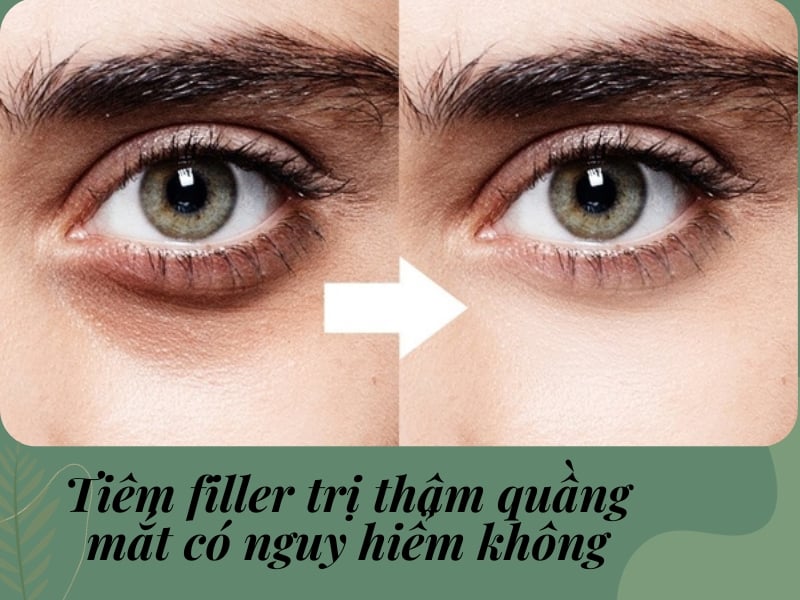 Tiêm tan quầng thâm mắt có nguy hiểm không?