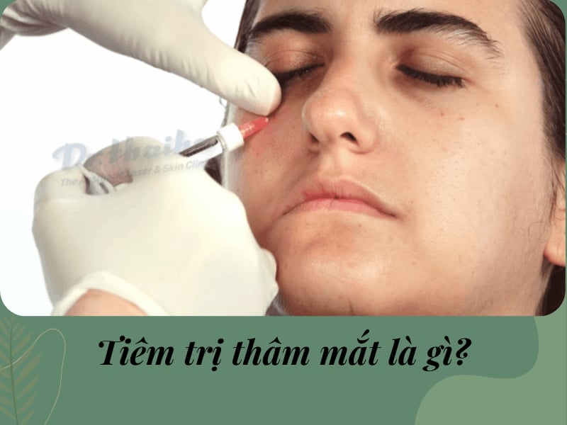 Tiêm filler trị thâm quầng mắt là gì?
