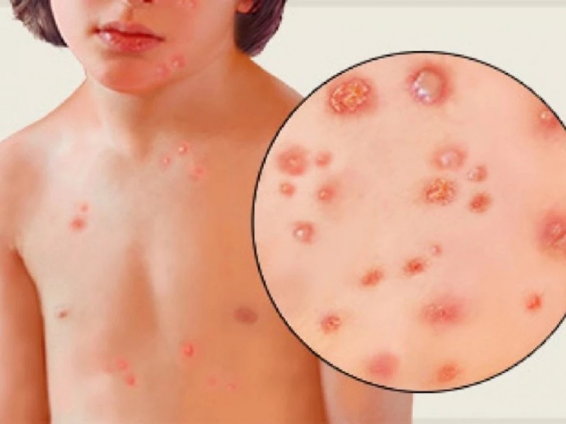 Tìm hiểu về bệnh thủy đậu