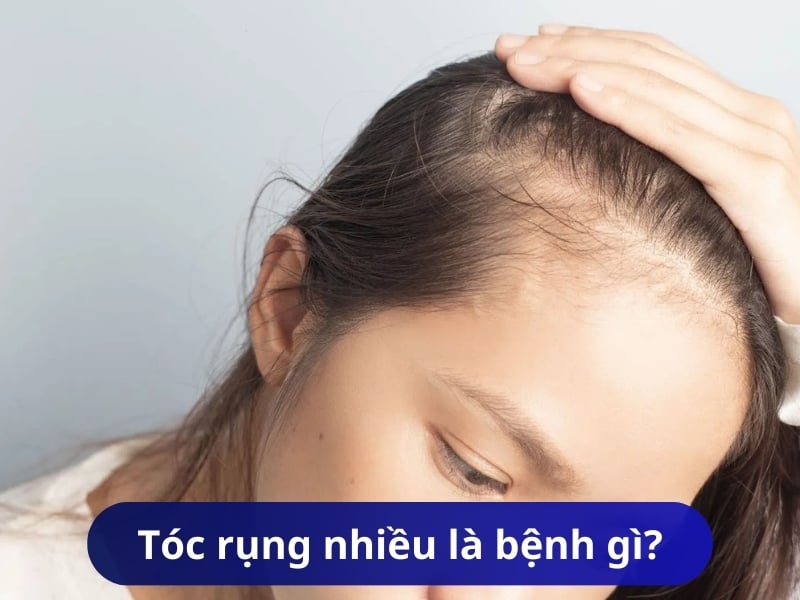 Tóc rụng nhiều là bệnh gì?