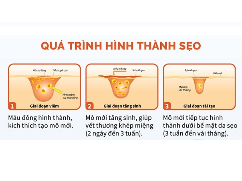 Tổng quan về cấu tạo da và cách hình thành sẹo lồi