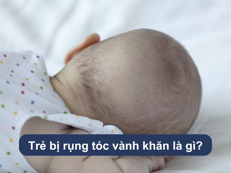 Trẻ bị rụng tóc vành khăn là gì?