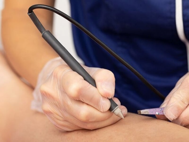 Triệt lông bikini bằng phương pháp điện phân (Electrolysis)