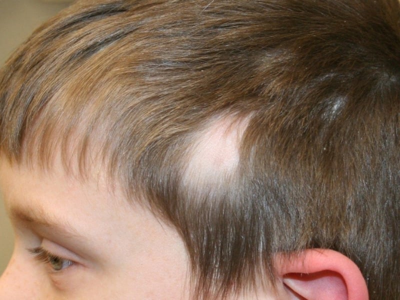 Triệu chứng và dấu hiệu rụng tóc ở trẻ em