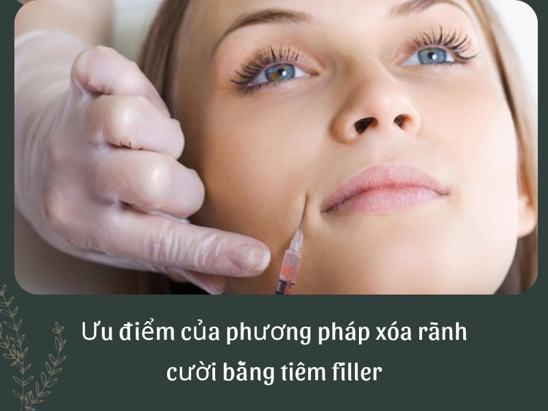 Ưu điểm của phương pháp xóa rãnh cười bằng tiêm filler