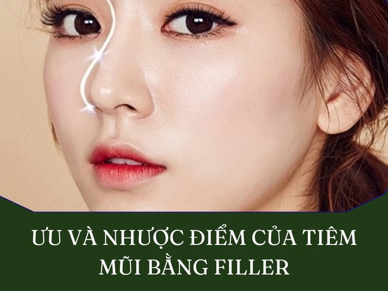 Ưu điểm và nhược điểm của tiêm mũi bằng filler