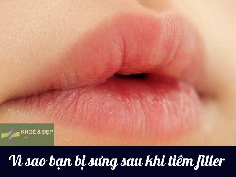 Vì sao lại bị sưng sau khi tiêm filler?