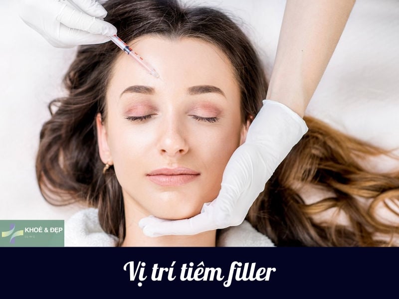 Vị trí tiêm filler