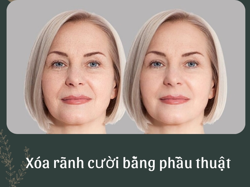 Xóa rãnh cười bằng phẫu thuật