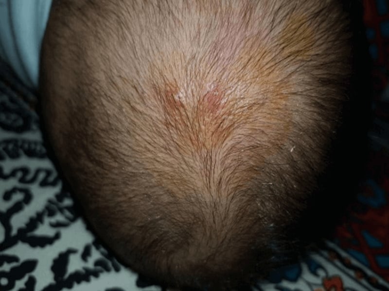 Nguyên nhân gây rụng tóc ở trẻ em 6 tuổi