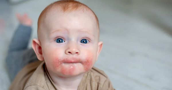 Đồ ăn dị ứng cho trẻ mà bố mẹ cần nên cẩn thận