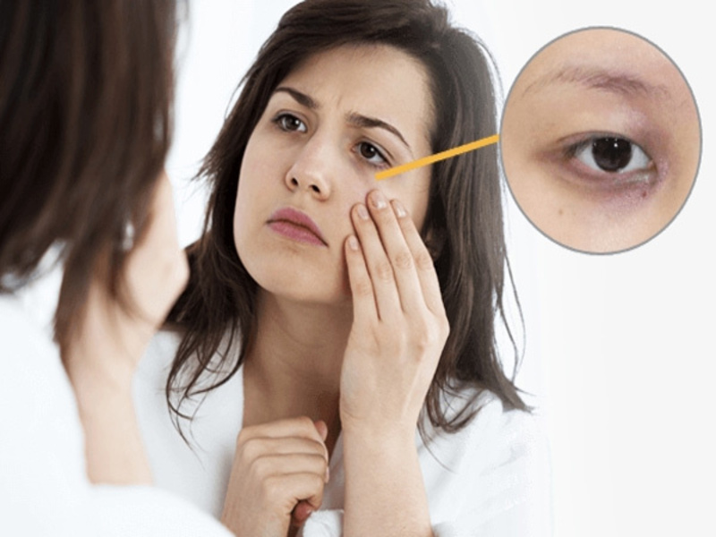 Mách bạn cách trị thâm quầng mắt nhanh nhất và hiệu quả nhất
