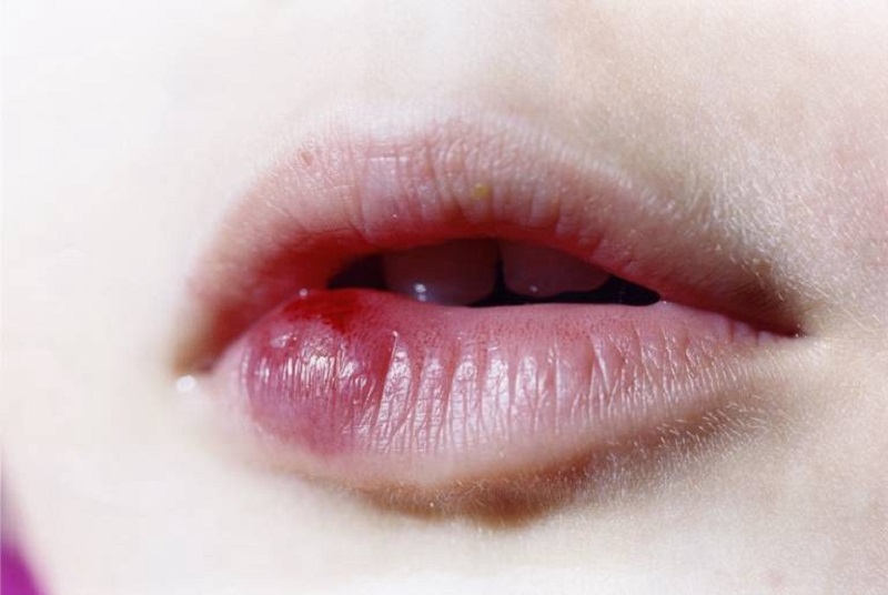 Những dấu hiệu của phun môi bị nhiễm trùng và cách xử lý