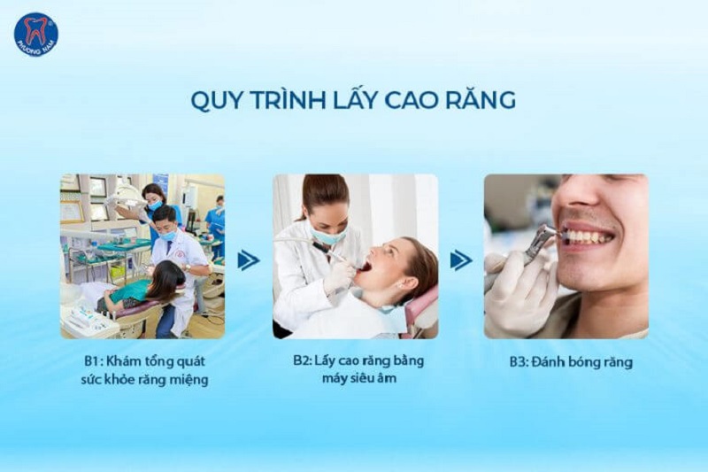 Bật mí top địa chỉ lấy cao răng tại Hà Nội uy tín và an toàn