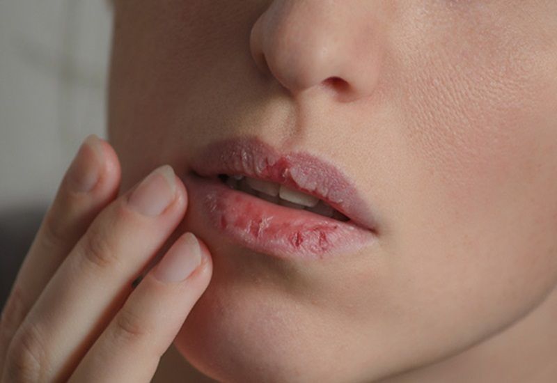 Kỹ thuật khử thâm môi là gì? Có hiệu quả vĩnh viễn không?