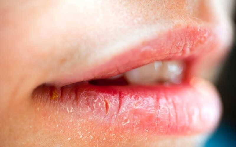 Phun môi bị bong da nhiều lần là do đâu? Khắc phục như thế nào?