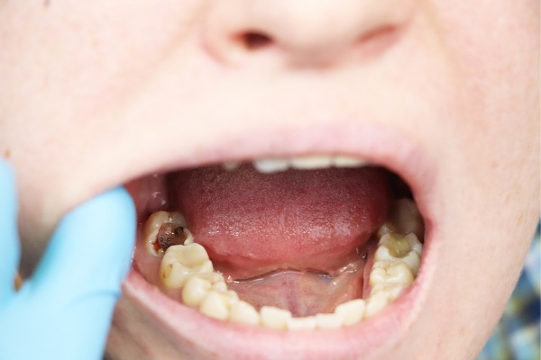 Cứ 10 người trưởng thành thì có 9 người bị sâu răng, và có thể bị sâu răng ngay cả khi răng không đau!