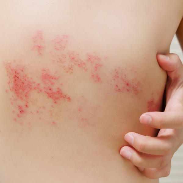 Sử Dụng Máy Cứu Ngải Chữa Bệnh Zona Thần Kinh – Giải Pháp An Toàn Và Hiệu Quả