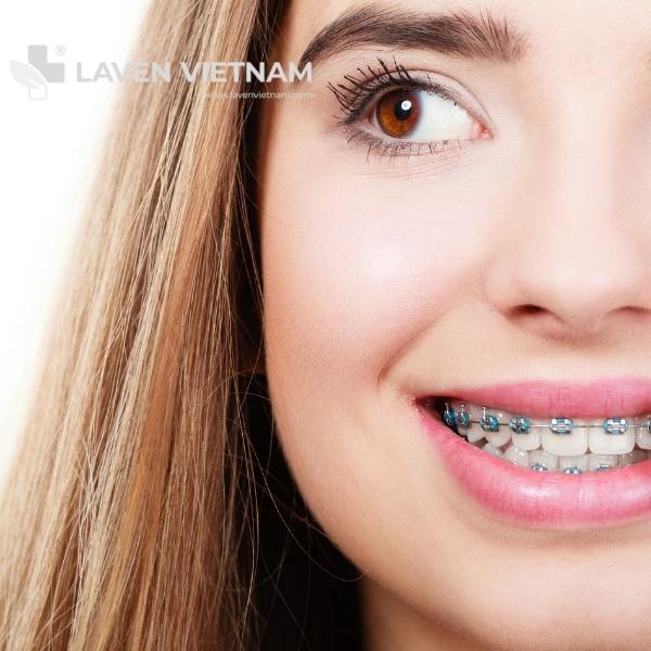 Những Lưu Ý Khi Niềng Răng và Cách Vệ Sinh Răng Niềng Đúng Cách