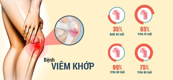 Đau cơ xương khớp là tình trạng phổ biến, ảnh hưởng đến khoảng 80% người từ 30-80 tuổi. Bệnh này có thể gây đau nhức dữ dội ở các khớp như khớp háng, khớp gối, vai, và cột sống