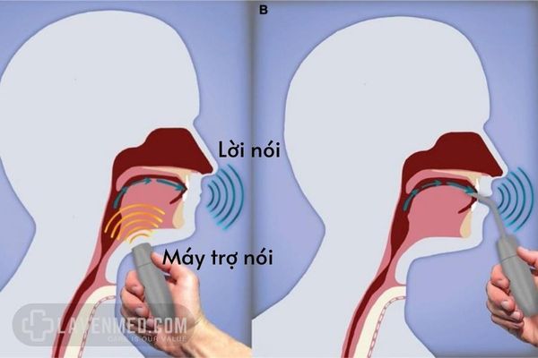 Máy trợ nói là một công cụ tuyệt vời trong hỗ trợ người cắt thanh quản tương tác được với người thân