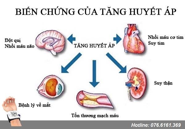 Đừng chủ quan với những biến chứng của tăng huyết áp.