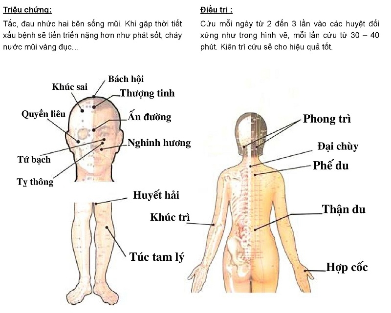 Hướng dẫn cứu ngải chữa viêm xoang bằng Máy cứu ngải Maxonga