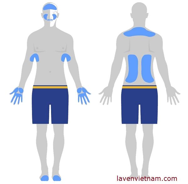 Có nhiều nguyên nhân gây ra đổ mồ hôi và số người bị ra mồ hôi ở chân tay nách chiếm chủ yếu