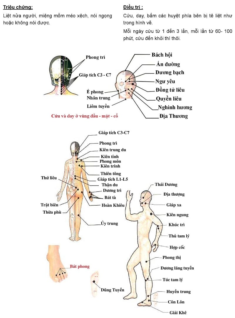 Cứu ngải chữa Di chứng liệt nửa người sau tai biến mạch máu não