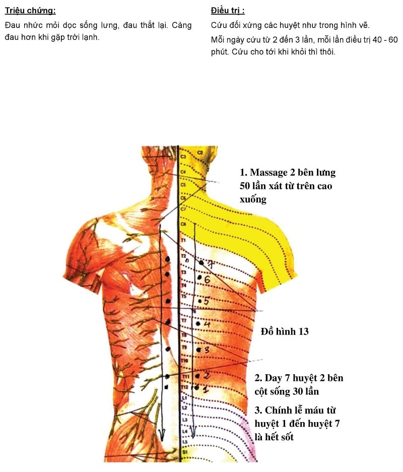 Chữa Đau Lưng Bằng Phương Pháp Cứu Ngải