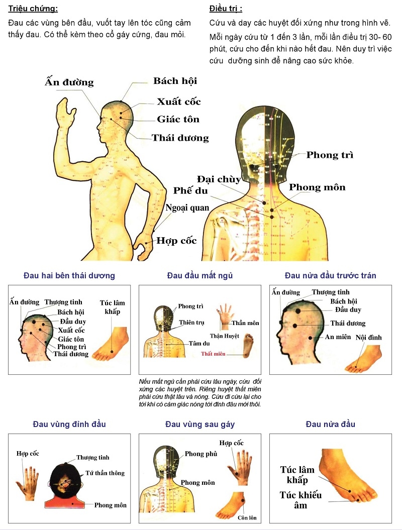 Cứu ngải chữa đau đầu