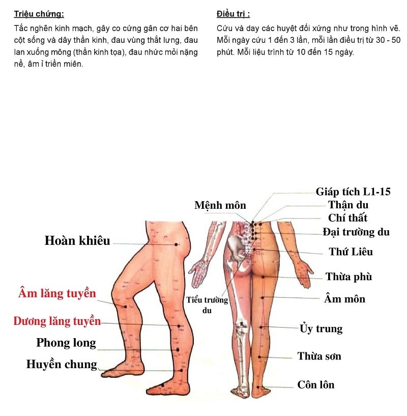 Cứu ngải chữa đau lưng, đau dây thần kinh tọa