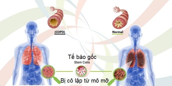 Một liệu pháp tiên phong sử dụng tế bào gốc tủy xương để điều trị cho bệnh nhân ung thư phổi đã được công bố tại Anh.