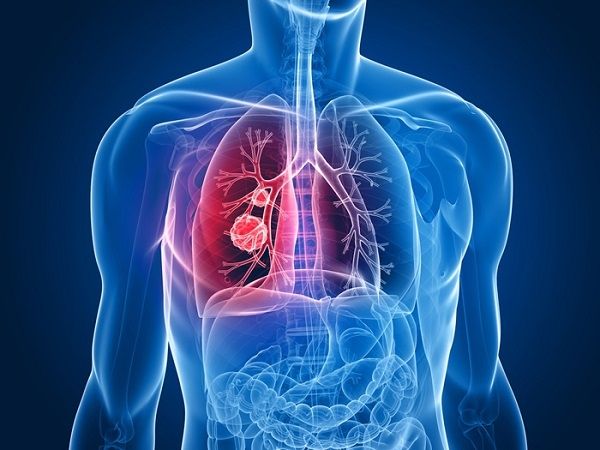 Liệu pháp tế bào gốc cho bệnh ung thư phổi bắt đầu thử nghiệm trên người