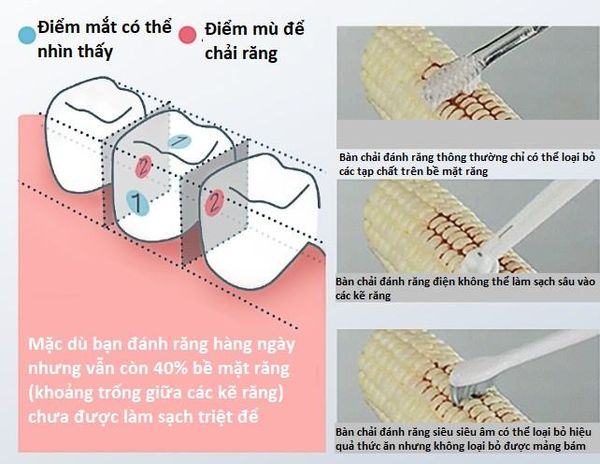 Điểm mù khi sử dụng bàn chải đánh răng