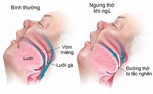 Hình ảnh biểu hiện của chứng ngưng thở khi ngủ so với người bình thường