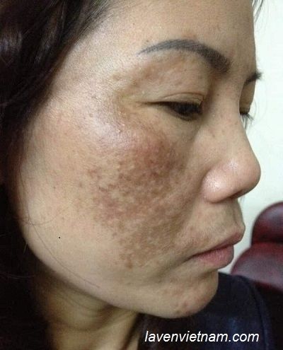 Nám da là sự lão hóa tự nhiên của da theo tuổi tác.