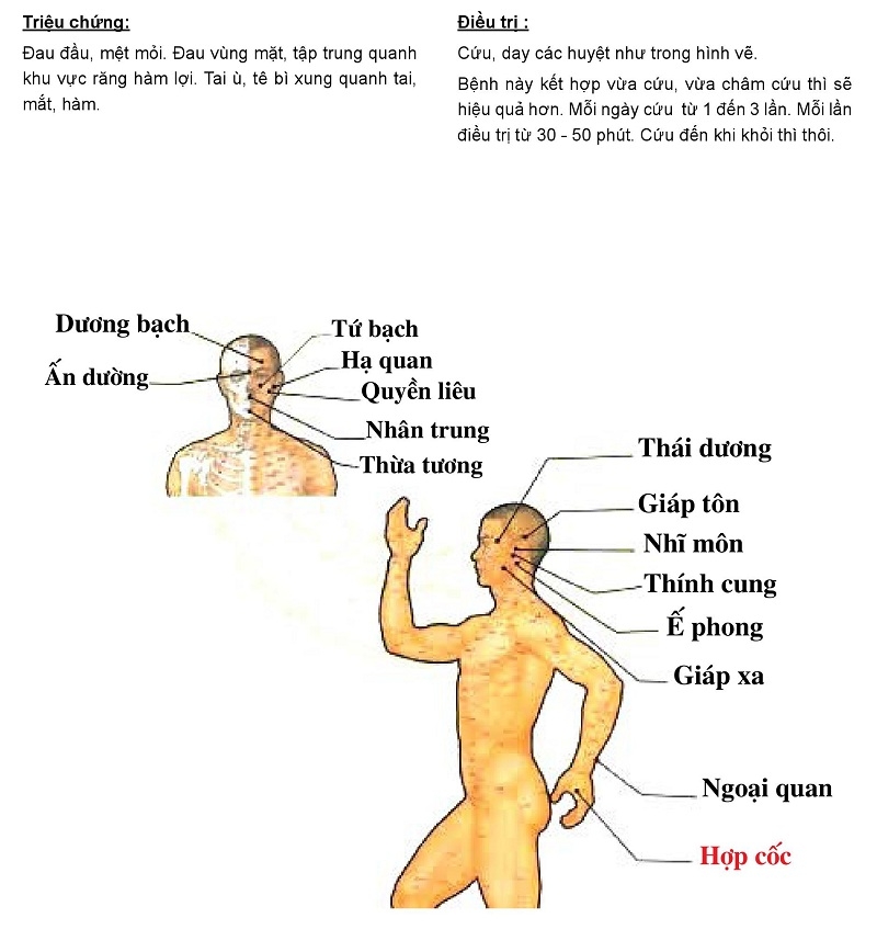 Cứu ngải chữa Liệt dây thần kinh số V