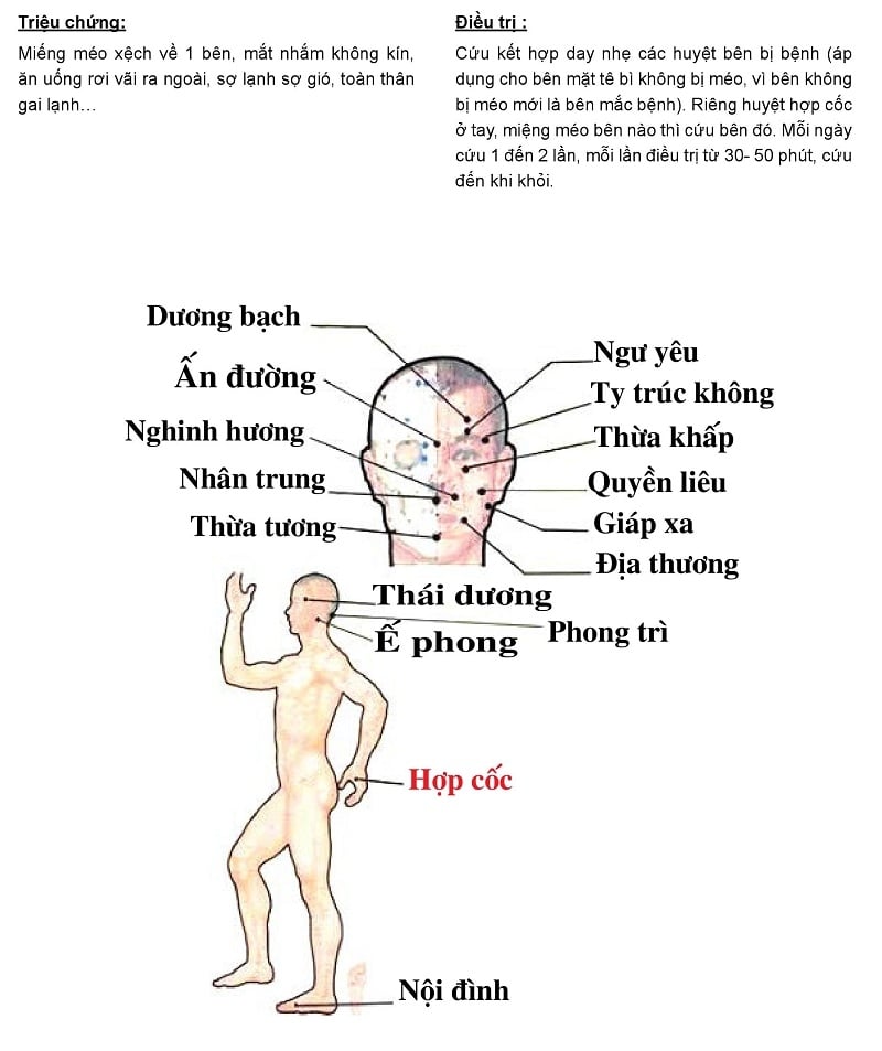 Chữa Liệt Dây Thần Kinh Số VII